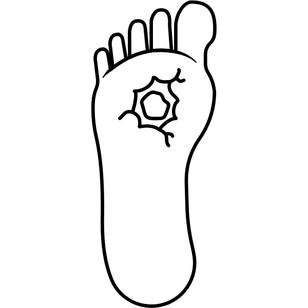 Pie diabético